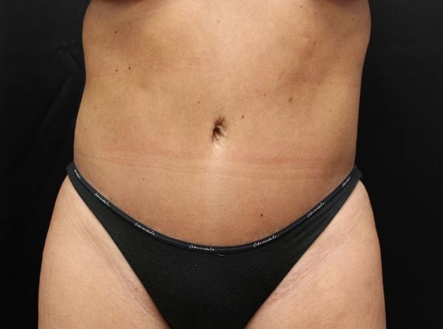 after tummy tuck front view female patient case 25