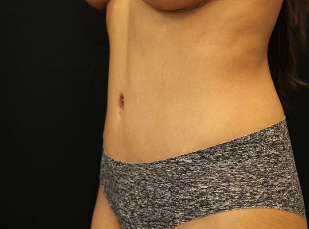 after tummy tuck left angle view female patient case 23
