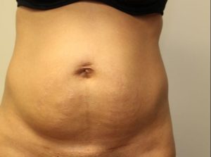 before tummy tuck front view female patient case 23