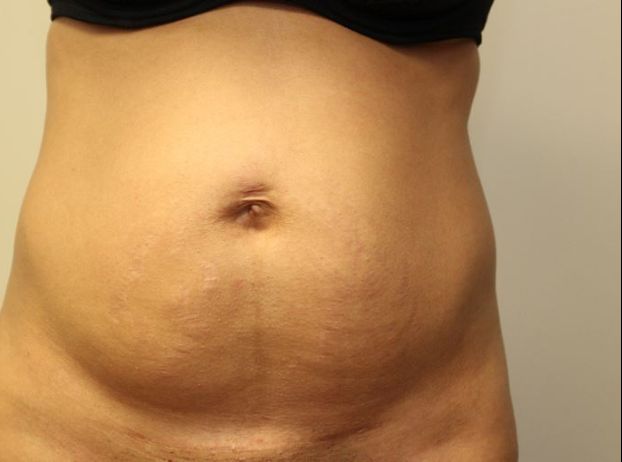 before tummy tuck front view female patient case 23
