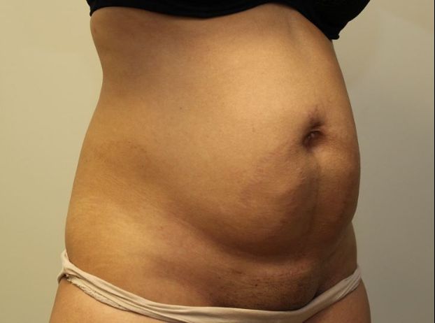 before tummy tuck right angle view female patient case 23