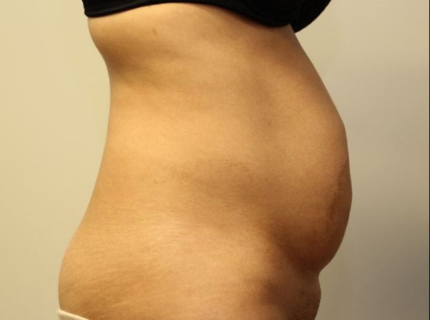 before tummy tuck right view female patient case 23