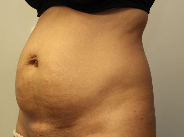 before tummy tuck left angle view female patient case 23