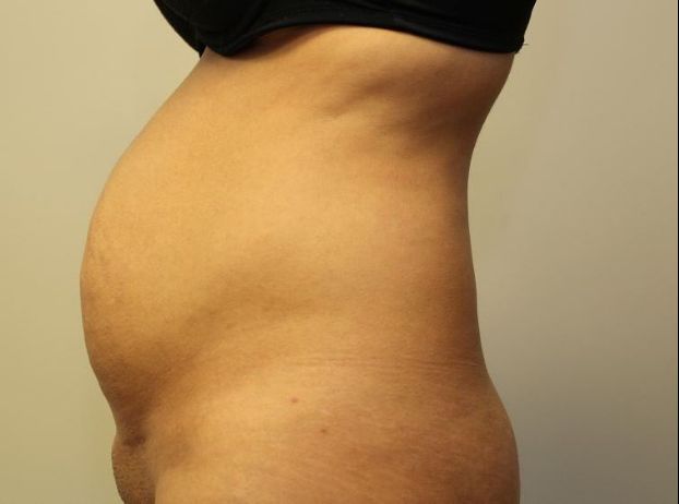 before tummy tuck left view female patient case 23