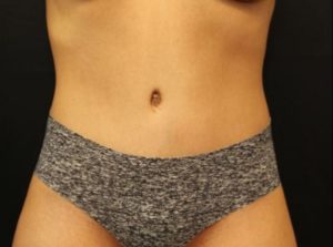 after tummy tuck front view female patient case 23