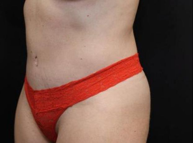 after tummy tuck left angle view female patient case 22