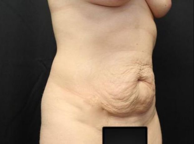 before tummy tuck right angle view female patient case 22