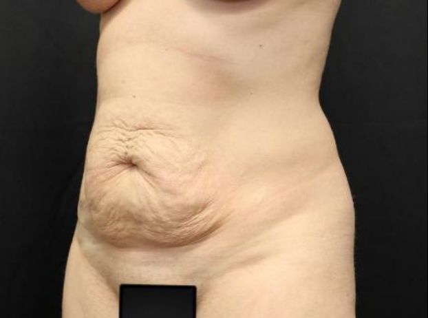 before tummy tuck left angle view female patient case 22