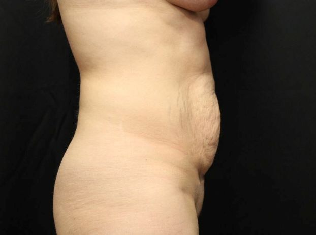 before tummy tuck right view female patient case 22