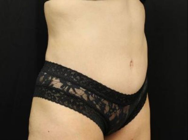 after tummy tuck right angle view female patient case 21