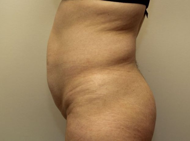 before tummy tuck left view female patient case 21