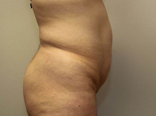 before tummy tuck right view female patient case 21