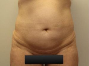 before tummy tuck front view female patient case 21