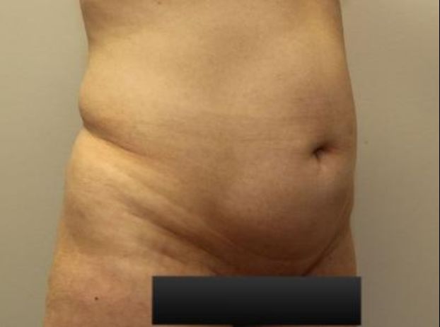 before tummy tuck right angle view female patient case 21