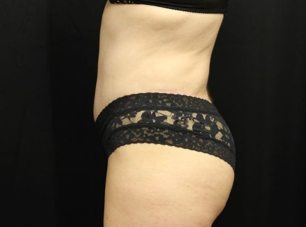 after tummy tuck left view female patient case 21