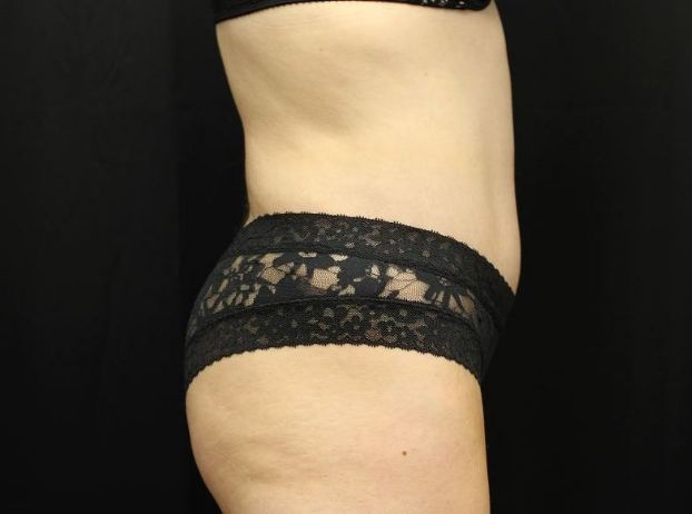 after tummy tuck right view female patient case 21