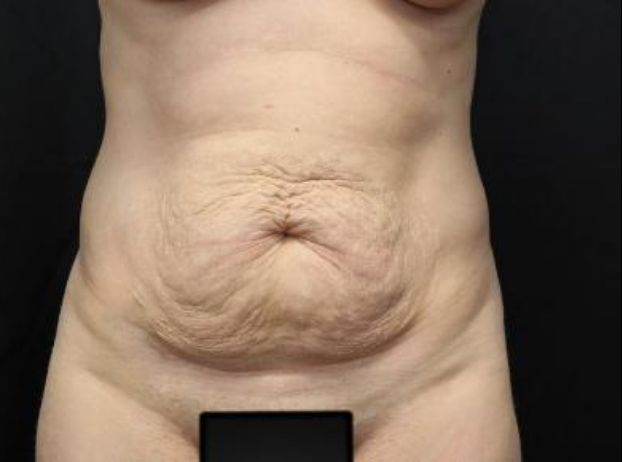 before tummy tuck front view female patient case 22