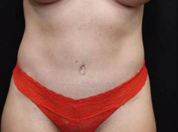 after tummy tuck front view female patient case 22