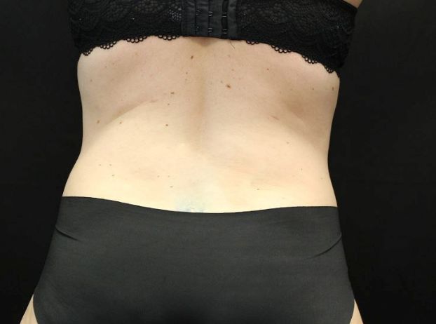 after tummy tuck back view female patient case 20