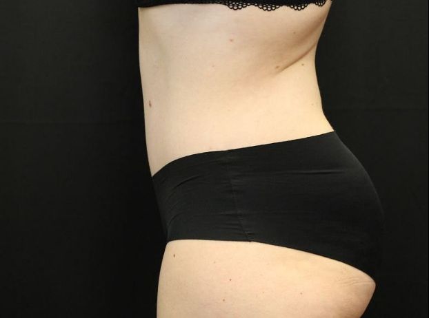 after tummy tuck left view female patient case 20