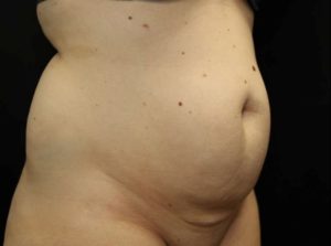 before tummy tuck right angle view female patient case 20
