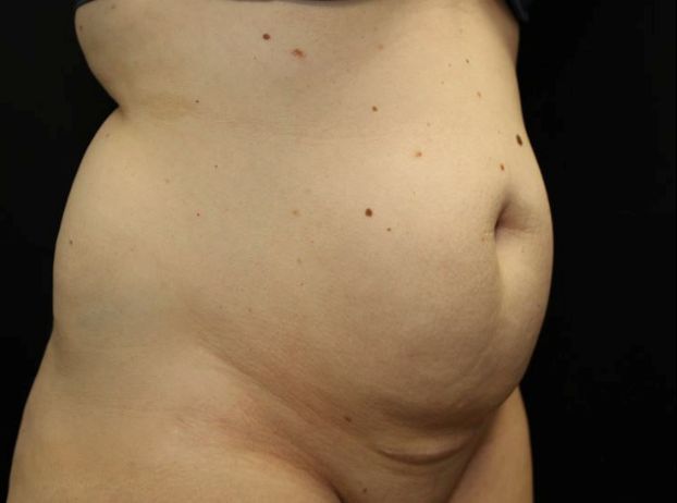 before tummy tuck right angle view female patient case 20