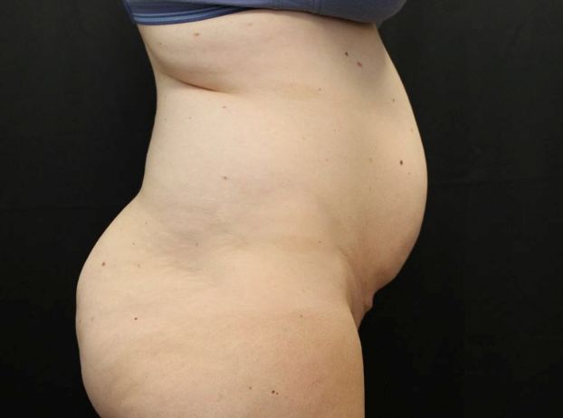 before tummy tuck right view female patient case 20