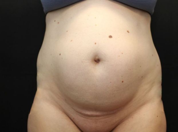 before tummy tuck front view female patient case 20