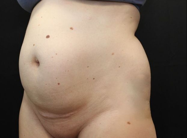 before tummy tuck left angle view female patient case 20