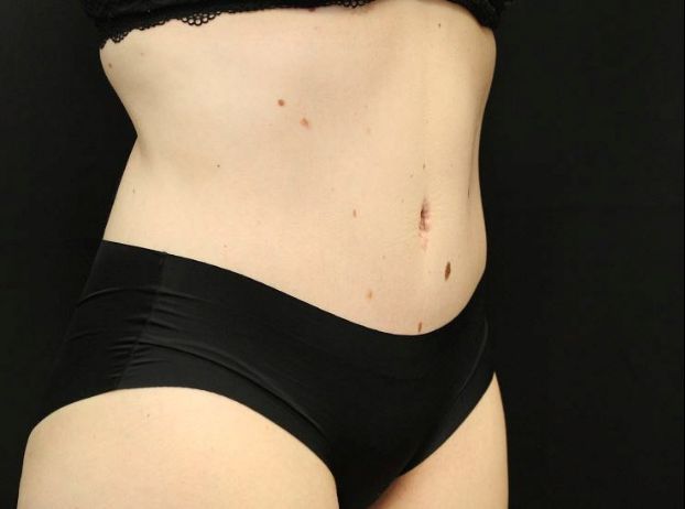 after tummy tuck right angle view female patient case 20