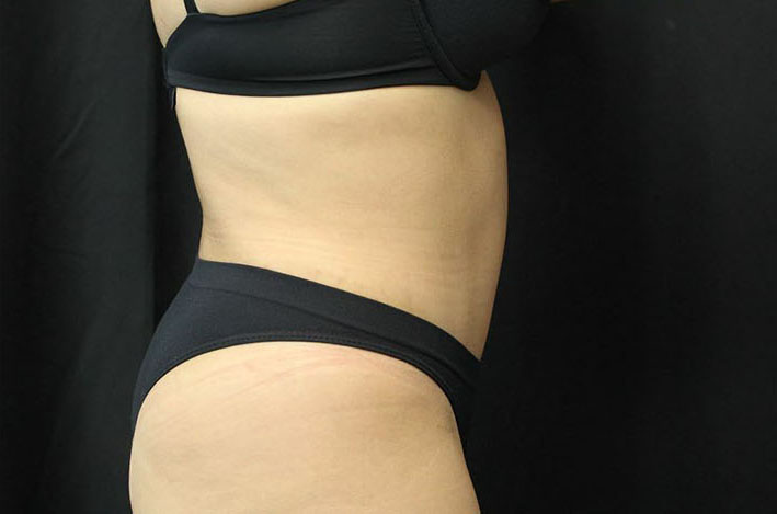 after tummy tuck right side view female patient case 41