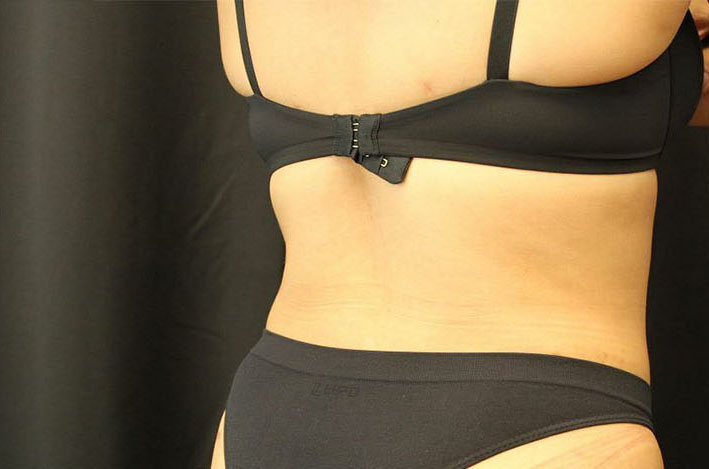 after tummy tuck back angle view female patient case 41