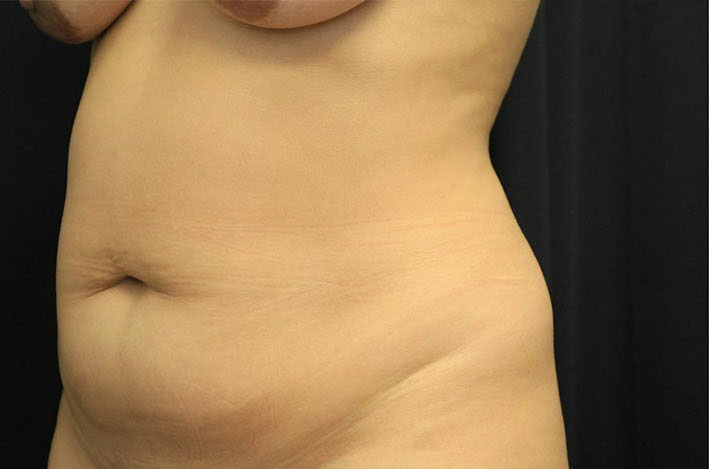 before tummy tuck left angle view female patient case 41