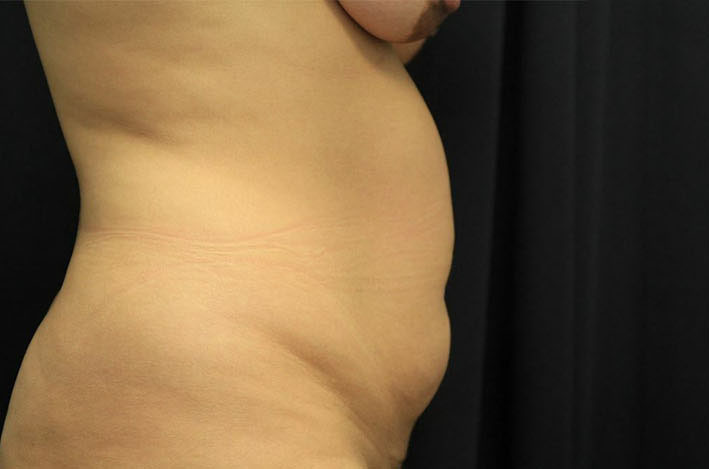 before tummy tuck right side view female patient case 41