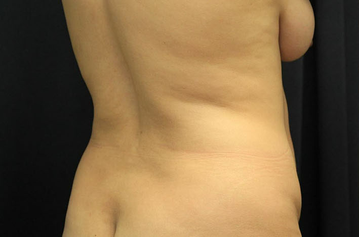 before tummy tuck back angle view female patient case 41