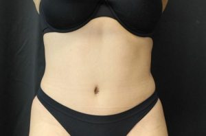after tummy tuck front view female patient case 41