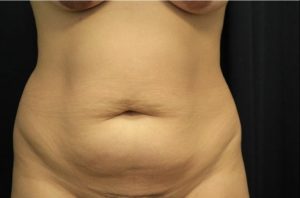 before tummy tuck front view female patient case 41