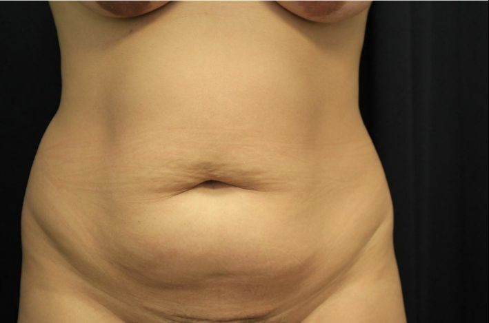 before tummy tuck front view female patient case 41