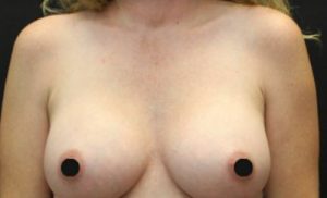 after breast augmentation front view case 14923