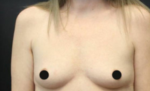 before breast augmentation front view case 14923