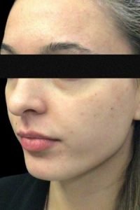 Before facial fille female patient angle view case 47