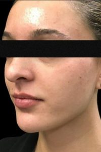 after facial fille female patient angle view case 47
